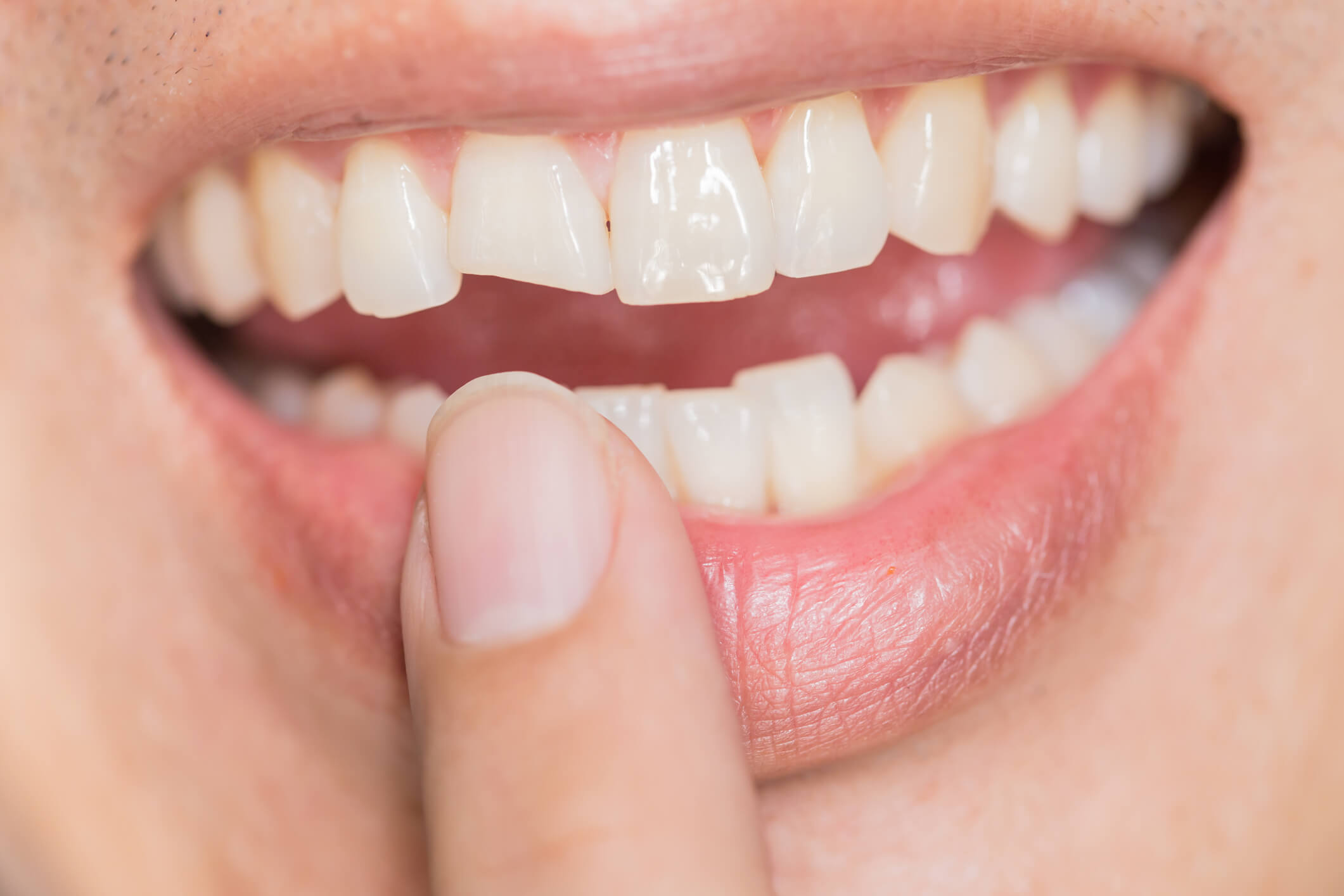 Dente quebrado? Descubra o que você deve fazer!