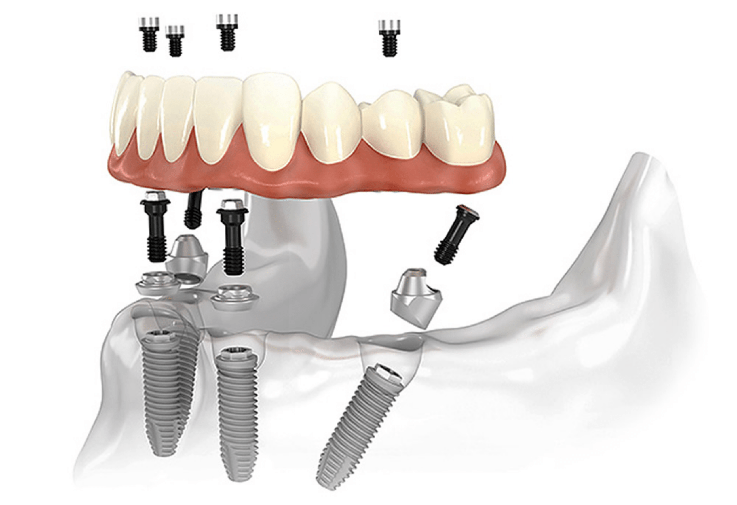 Dentes fixos em até 72 horas: Conheça a carga imediata.