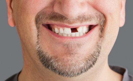 Descubra quais são as causas da perda de dente 